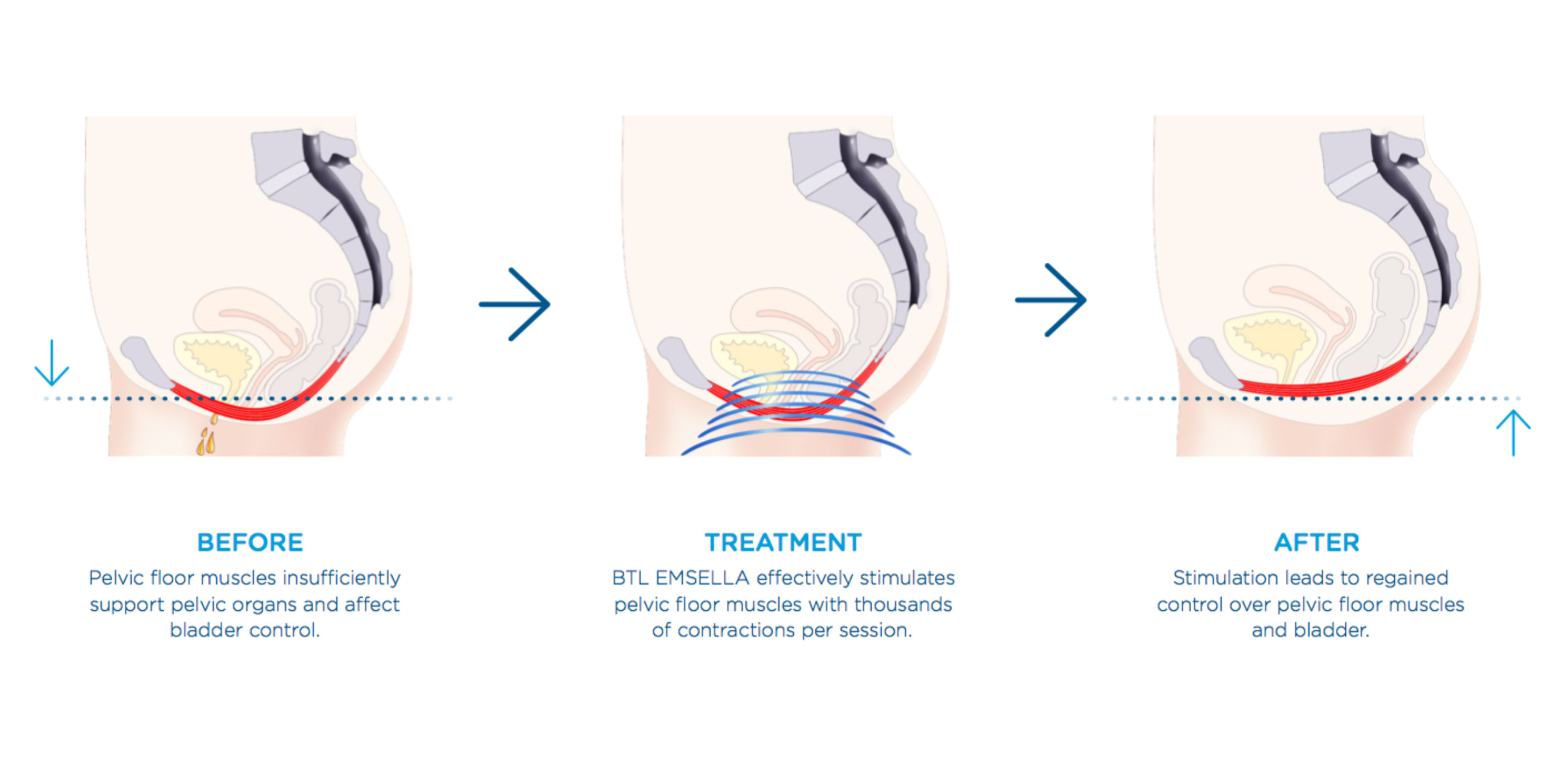Pelvic Prep With Emsella - The Treatment Transforming Women’s Intimate Health 3 Pelvic Prep With Emsella - The Treatment Transforming Women’s Intimate Health • 3