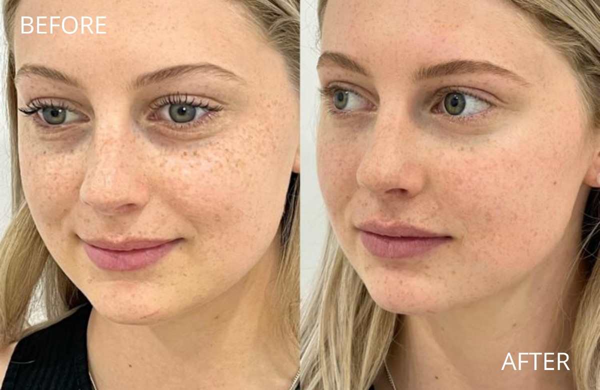 Tear Trough Filler - What is it And Why You Should Try It! 3 Tear Trough Filler - What is it And Why You Should Try It! • 3