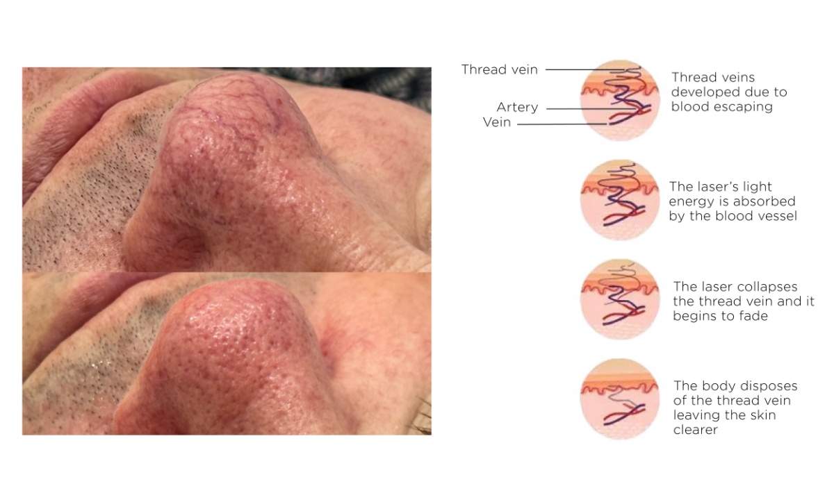 Winter Skin Wonders - Laser Therapy &bull; 4
