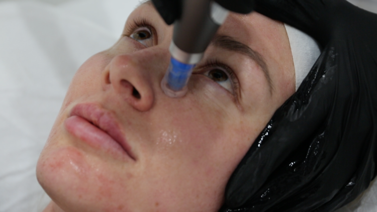 Dermapen Skin Needling &bull; 13