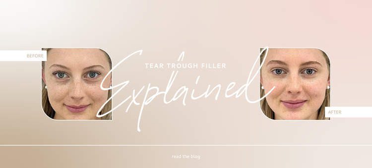 Tear Trough Filler - What is it And Why You Should Try It! &bull; 57