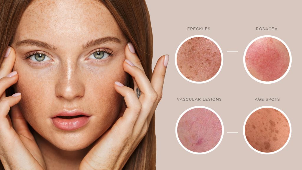 Lumecca by InMode 2 Lumecca treats an array of skin conditions