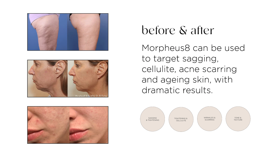 Chosen by Kim Kardashian: Morpheus8 4 Morpheus8 Before & Afters