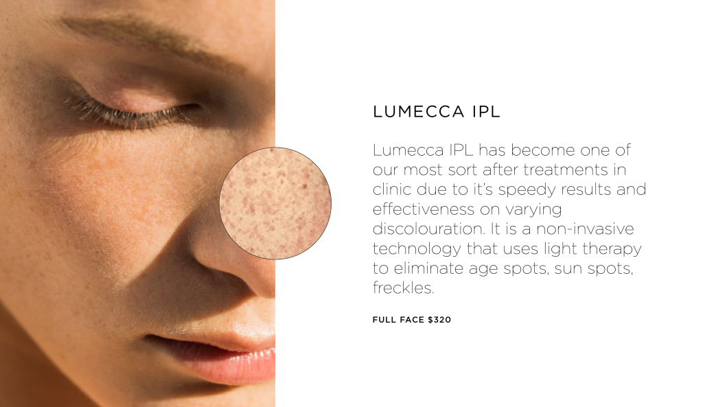 PSA: pigment can be corrected 2 Pigment can be corrected with Lumecca IPL