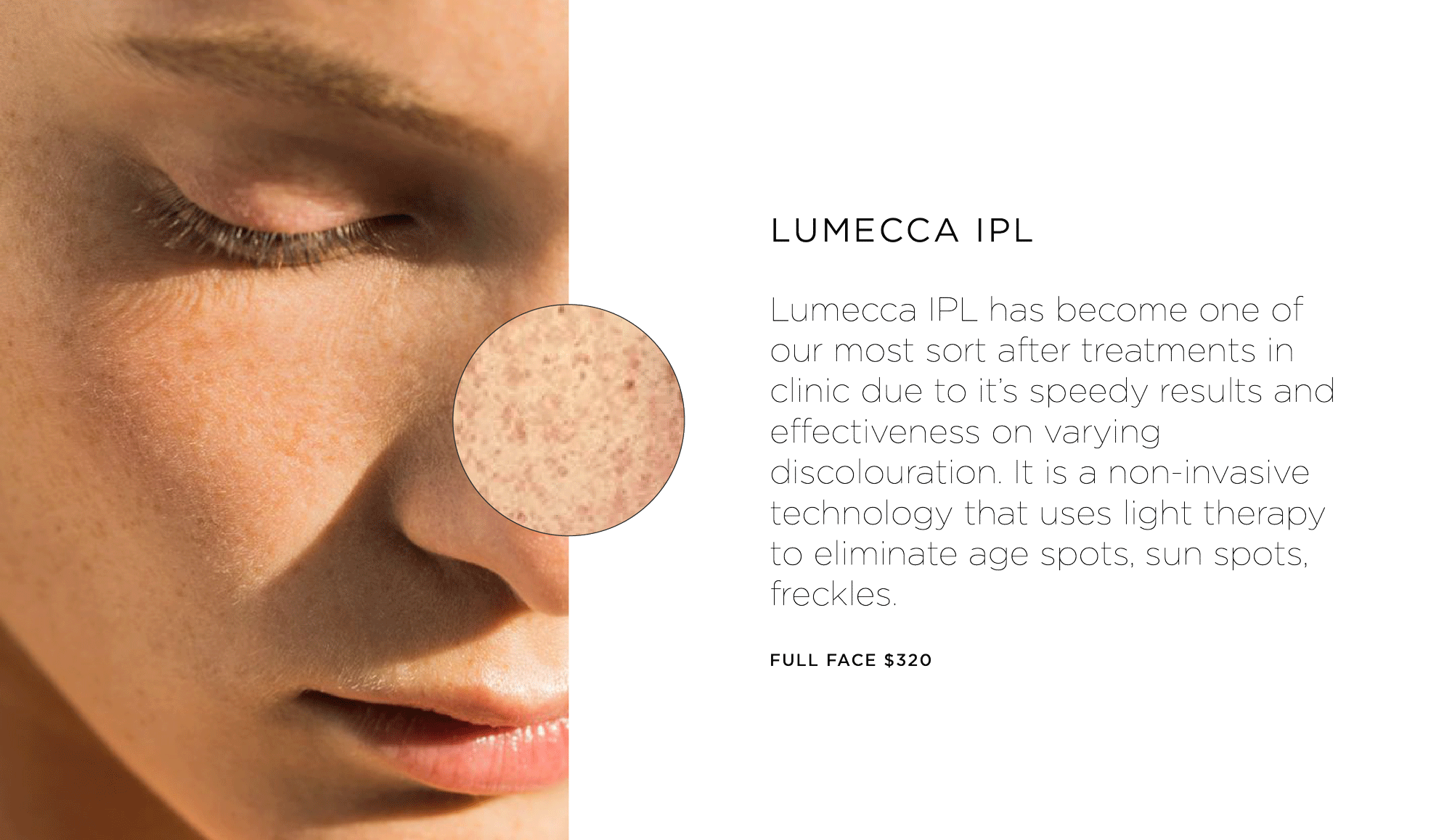 Pigment can be corrected with Lumecca IPL 