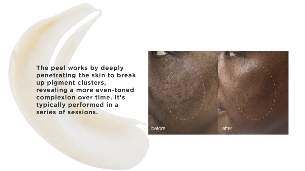 Melasma Unmasked with MelanoPro by Dermalogica 3 Treatment for melasma
